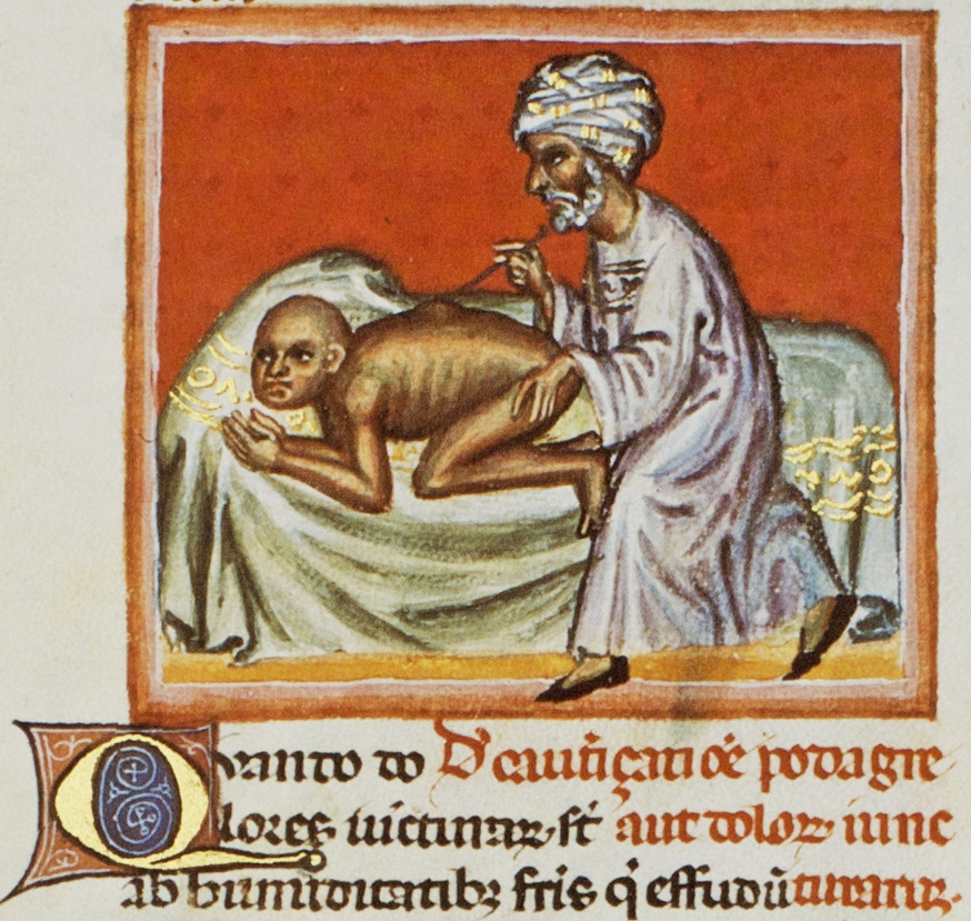 Lancing a boil (Abu'l Qasim Halaf ibn Abbas al-Zahraui - Chirurgia, Southern Italy - 2nd half of the 14th century). Lancing a boil (Abu'l Qasim Halaf ibn Abbas al-Zahraui - Chirurgia, Southern Italy - 2nd half of the 14th century).